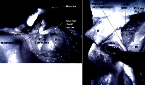Fig. 4. Photographs obtained while dissecting cadaver specimens. Left: Medial view of the right juxtadural ring area. The tip of the silver dissector is inside the carotid cave.