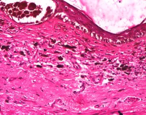 Apoptosis in cutaneous melanomas 345 Figure 1 Lentigo maligna show