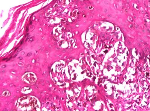 cell layer, nest with atypical melanocytes between junction (HE, 10