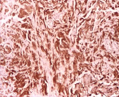 few apoptotic tumoral cells + (40 ) Figure 8