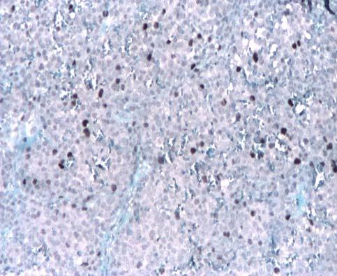 fluorescent signal in apoptotic tumoral cells (40