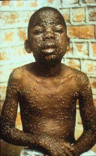 Smallpox (Variola) Smallpox is a serious, contagious, and sometimes fatal infectious disease. There is no specific treatment for smallpox disease, and the only prevention is vaccination.