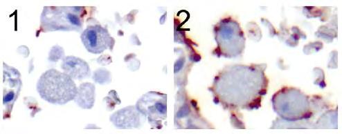 2009 H1N1 D225G 11% 53% Increased binding to human type II pneumocytes and alveolar macrophages