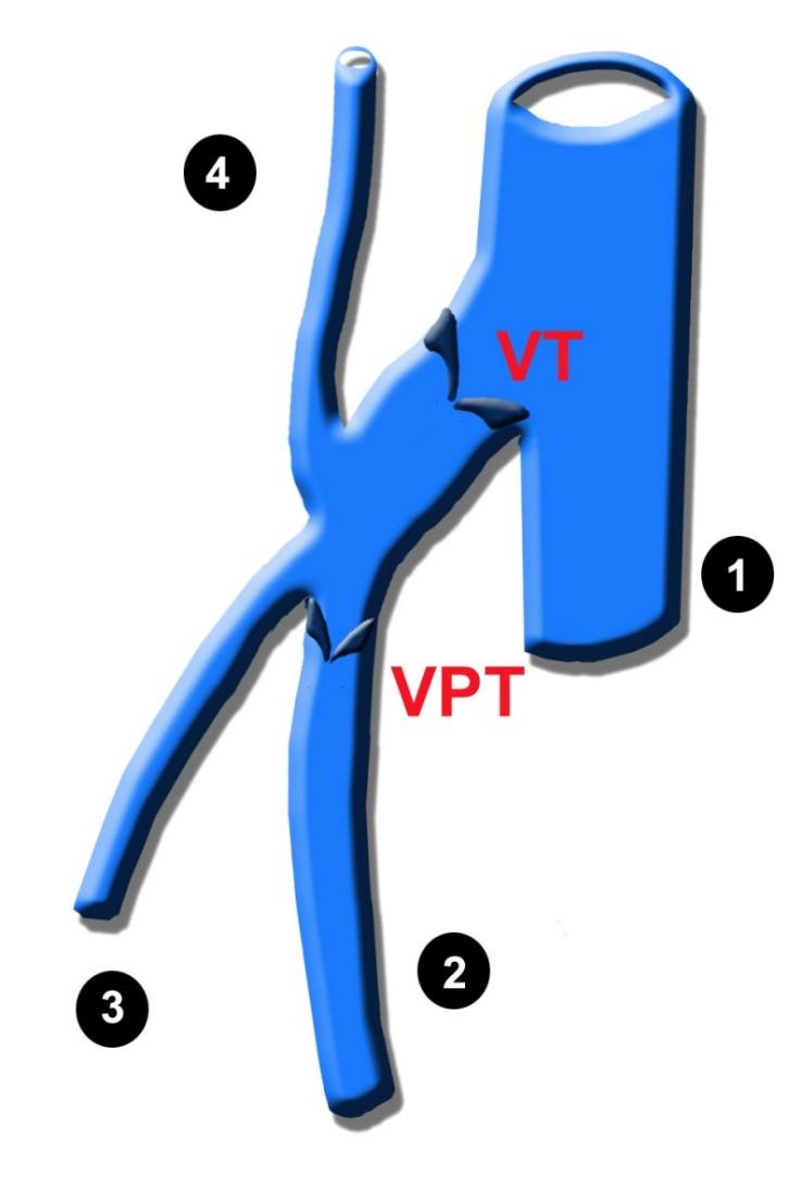 Saphenopopliteal junction : hemodynamic reminder (1) popliteal vein (2) SSV (3) tributary (4) anastomose of Giacomini varicose vein