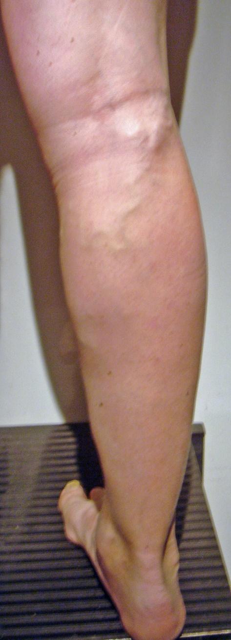 Poplitea fossa perforator ( PFP ) characteristic clinical aspect 2cm above knee fold,