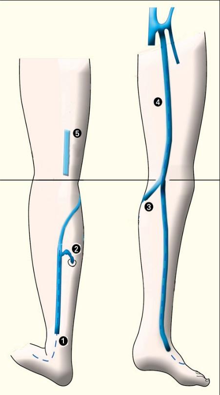 Saphenopopliteal junction : anatomical reminder small saphenous veins WITHOUT
