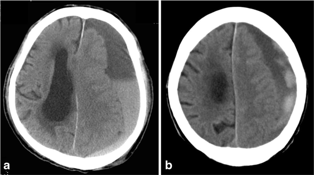 Fig. 1 a Computed tomography (CT) shows chronic subdural hematoma (CSDH) with niveau formation on computed tomography.