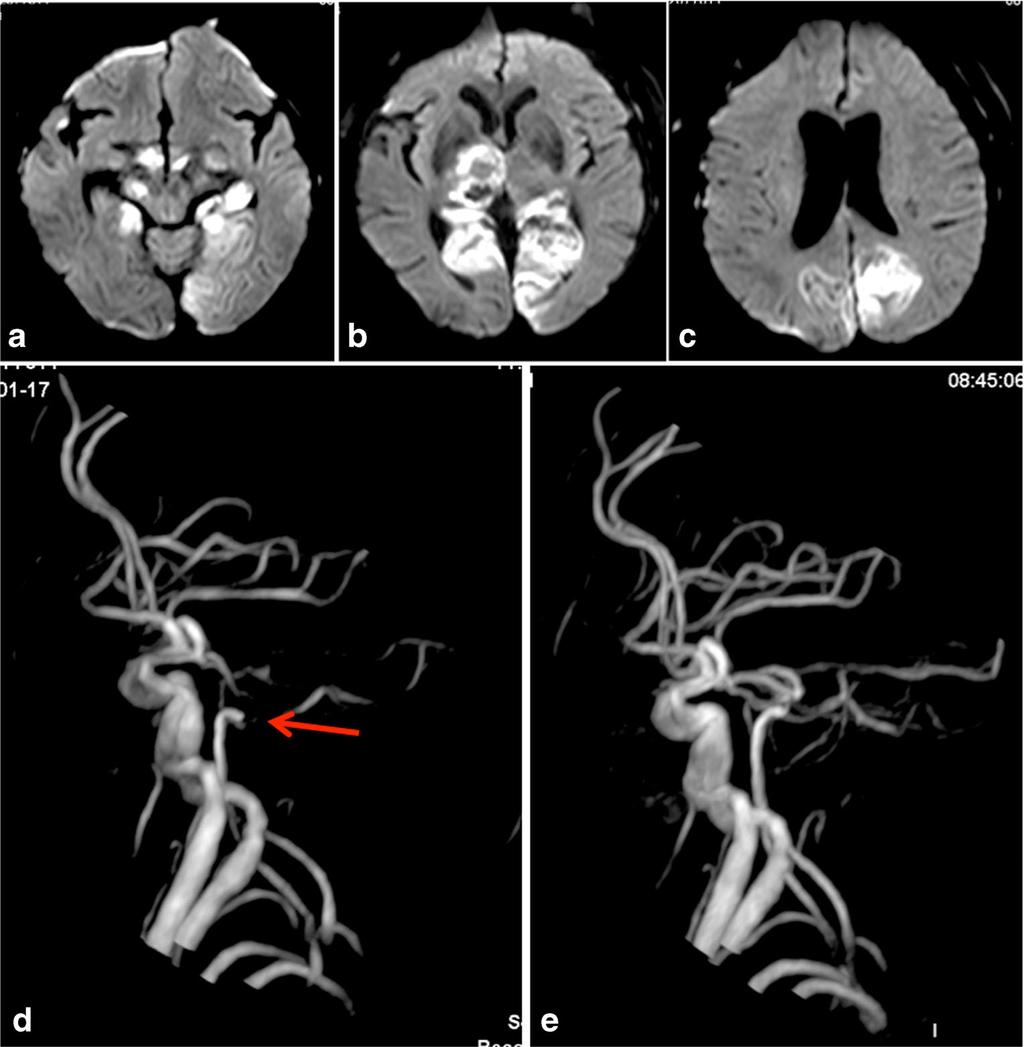 Fig. 3 a c Postoperative diffusion-weighted imaging in case 4 shows acute cerebral infarction in the bilateral occipital lobes, bilateral thalami, and brainstem.