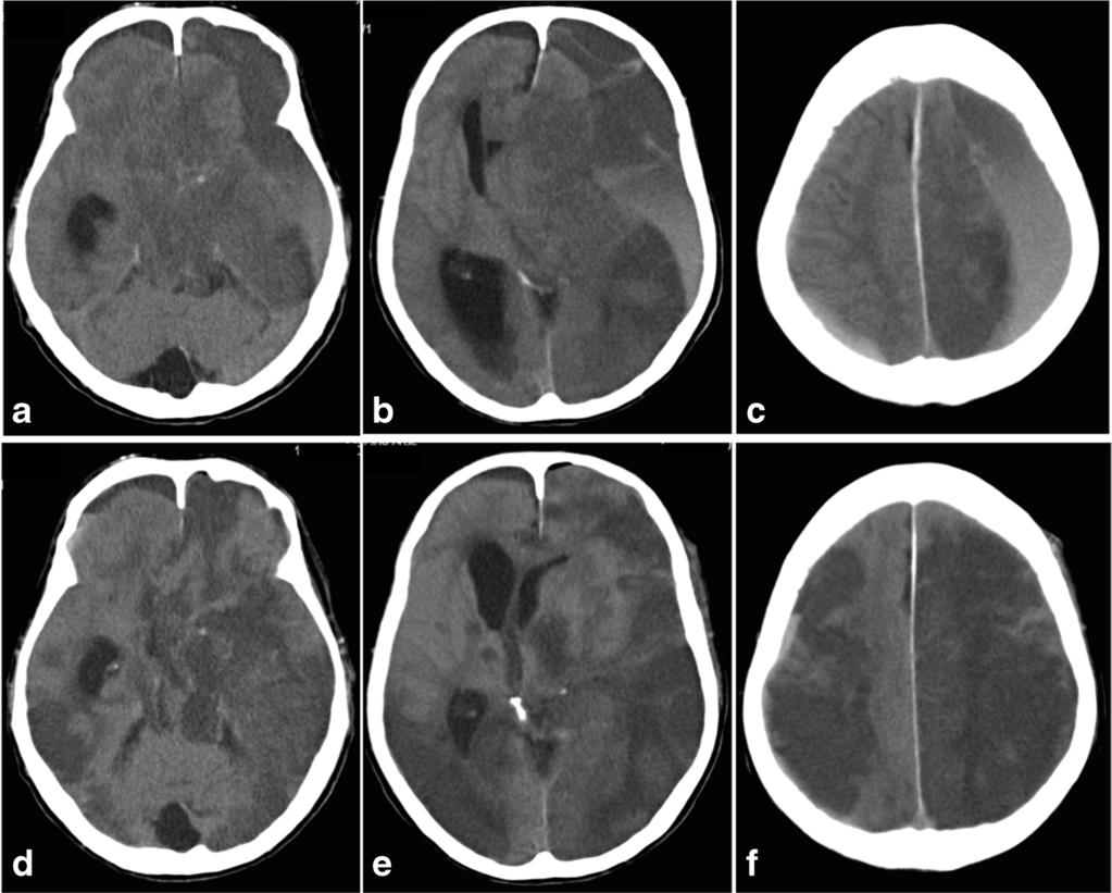 Fig. 4 a c Preoperative computed tomography (CT) in case 5 shows a massive left chronic subdural hematoma with niveau formation, a high-density area in the basal cistern, and disappearance of the