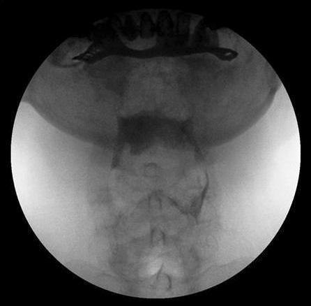 (B) The lateral projection shows much barium residue in the vallecula and pyriform sinus after swallowing the solid component. CASE REPORT Fig. 2.