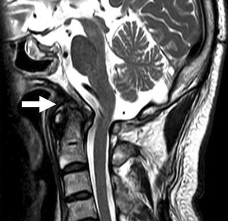 A 59-year-old male visited the rehabilitation department because of ongoing difficulty swallowing. Two months earlier, a 15-kg piece of iron was dropped on his neck from a height of 10 m.