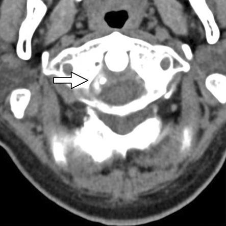 on the right side (arrow). 3). For the treatment of the posterior atlanto-occipital dislocation, surgery was recommended, but the patient refused.