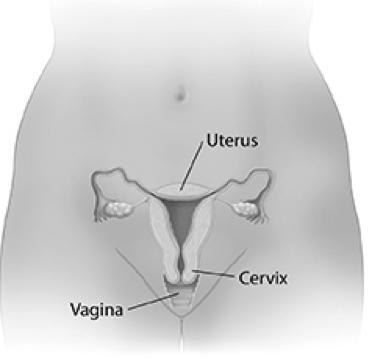 Cervical cancer is a disease in which malignant (cancer) cells form in the tissues of the cervix. The cervix is the lower, narrow end of the uterus (the hollow, pear-shaped organ where a fetus grows).