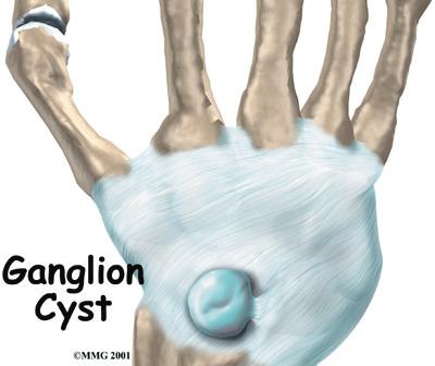 Introduction A ganglion is a small, harmless cyst, or sac of fluid, that sometimes develops in the wrist.