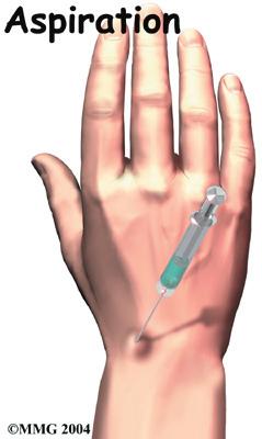 The wrist may ache or feel tender. The ganglion may also interfere with activities. A volar wrist ganglion may compress the median or ulnar nerve, causing trouble with sensation and movement.