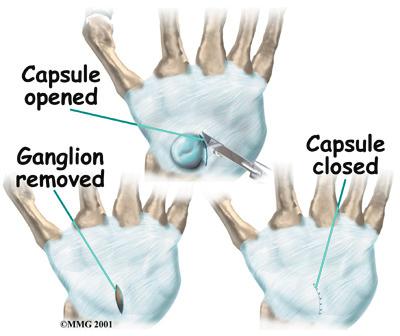 is made, but depending on the location of the ganglion, a second incision may be necessary. Removing a volar wrist ganglion To remove a ganglion, a small incision is made in the back of the wrist.