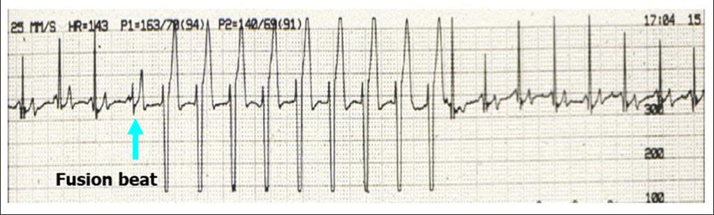 Accelerated Idioventricular Rhythm Slow Vtach Normal rate Seen in dogs after GDV Seen in pets with severe