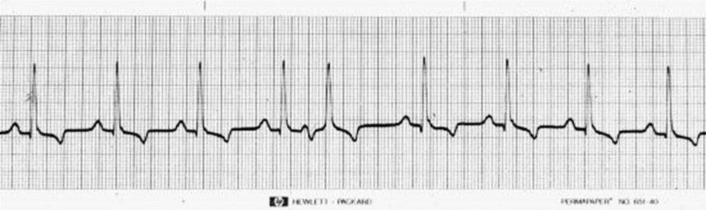 Atrial Premature Complexes Similar to normal complexes but comes early May or may not see P-wave Pause after premature
