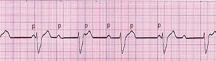 3 rd degree AV Block Complete dissociation of P waves and QRS complex