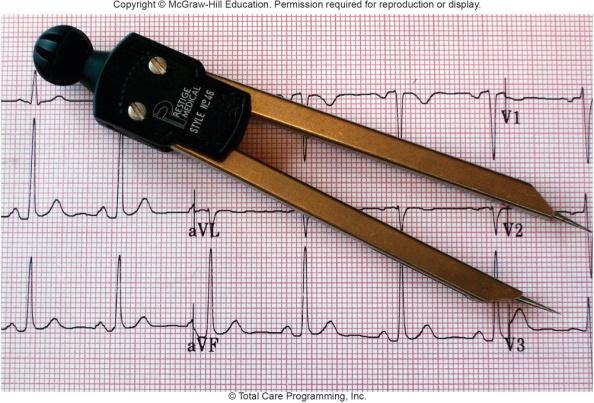 Learning Outcomes 5.1 Explain the process of evaluating ECG tracings and determining the presence of dysrhythmias. 5.2 Describe the criteria used to classify dysrhythmias, including rhythm, rate, P wave morphology, PR interval measurement, and QRS duration measurement.