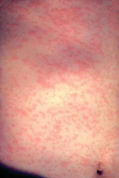 MEASLES Vitamin A supplementation is recommended for acute measles FIGURE 2. Measles on the 3rd day of rash. FROM THE US CENTERS FOR DISEASE CONTROL AND PREVENTION.