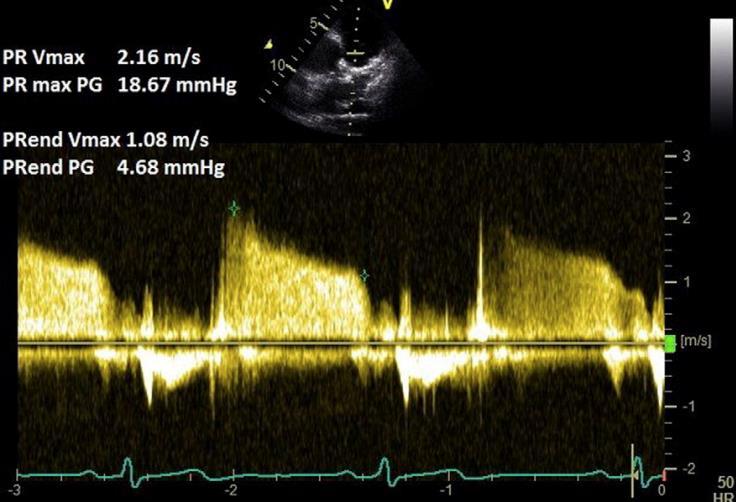 Diagnosis Doppler-echo: The non-invasive RHC PASP = (4V 2 peak jet velocity of TR) + RA