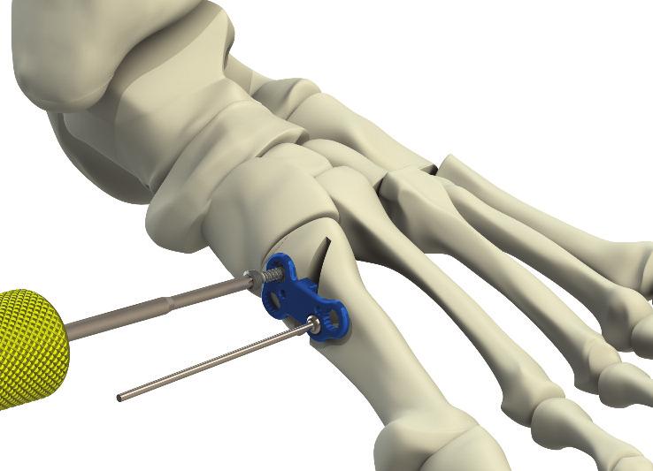 Extend the hook probe out of the depth gauge far enough to reach the lateral aspect of the metatarsal.