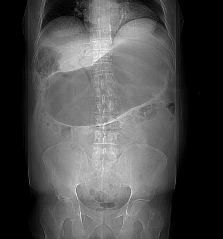 36 cm Figure 1 Scout film. Pneumobilia (dotted arrow) and ectopic gallstone (solid arrow). Marked gastric distention, with small bowel obstruction less clearly seen.