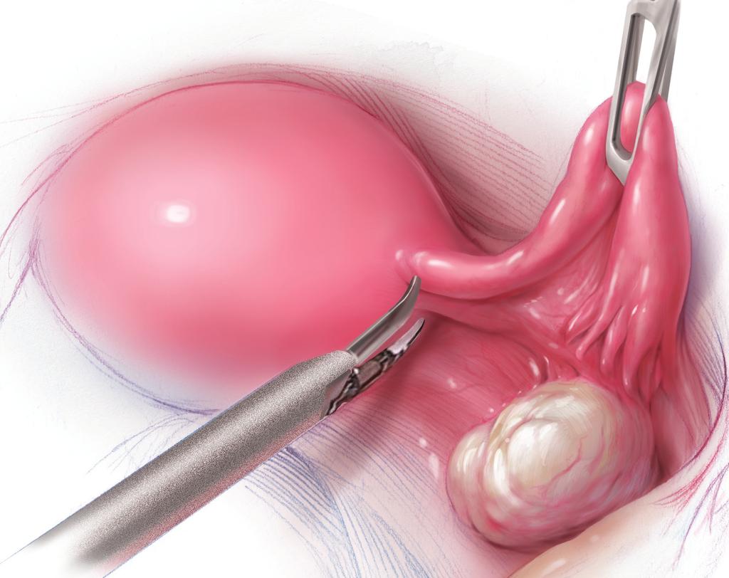 ILLUSTRATION: KIMBERLY MARTENS FOR OBG MANAGEMENT FIGURE 1 When hysterectomy is planned, a number of variables influence whether concomitant oophorectomy or salpingectomy is advisable, including the