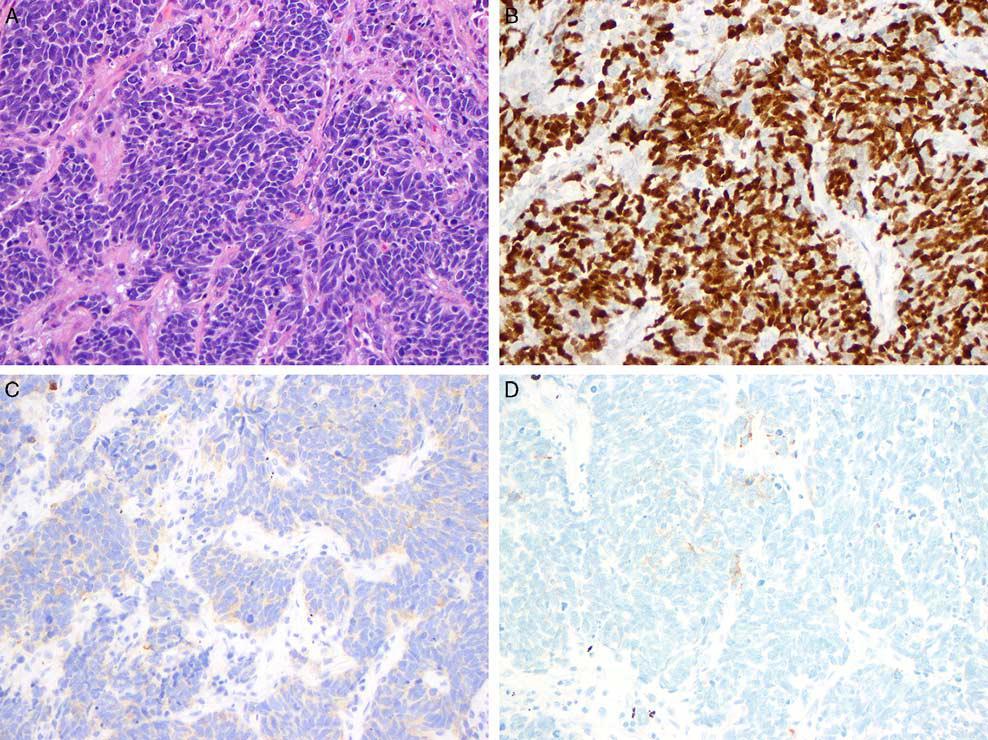 INSM1 is a useful neuroendocrine marker in lung biopsy and surgical specimens