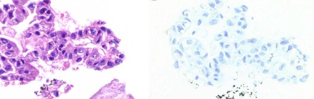 cell carcinoma Adenocarcinoma Images