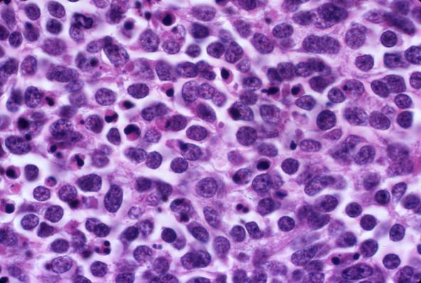 SMALL CELL CARCINOMA WHO Definition small cells with scant cytoplasm, illdefined cell