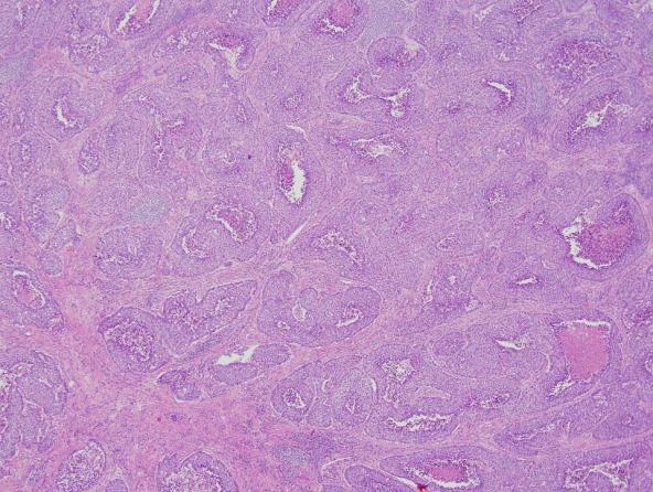 LARGE CELL CARCINOMA WHO 2004 poorly differentiated NSCLC that lacks cytologic and architectural features of SCLC and glandular or squamous differentiation 5 variants: large cell