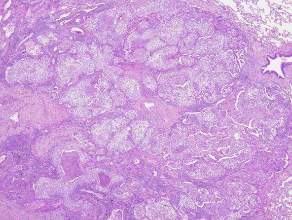 Large Cell Neuroendocrine Carcinoma Conclusion Neither cell size nor