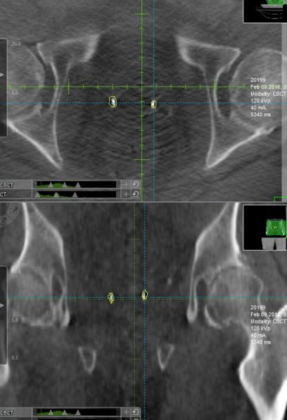 confirmation and monitoring after each couch movement Stereo Oblique CBCT Level of Difficulty for setup and treatment Robotic Couch 3D CBCT Stereo X-ray Remote Operation of Accessories