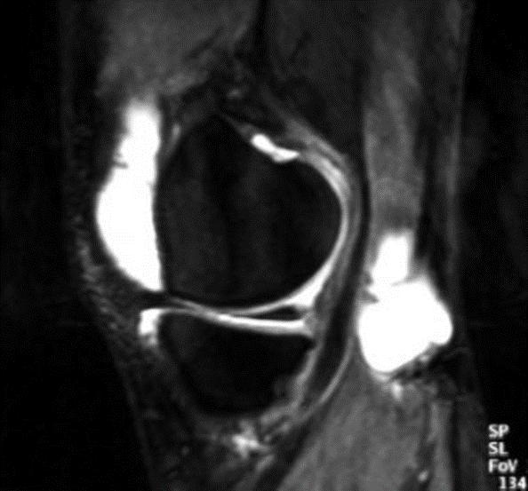 Table2 Anterior Meniscus injury Posterior Meniscus injury Cruciate Ligament Injury Meniscus & Cruciate Ligament Injury Baker s cyst 3 14 3 4 24 Total In MRI, Baker s cyst appears as a well-defined