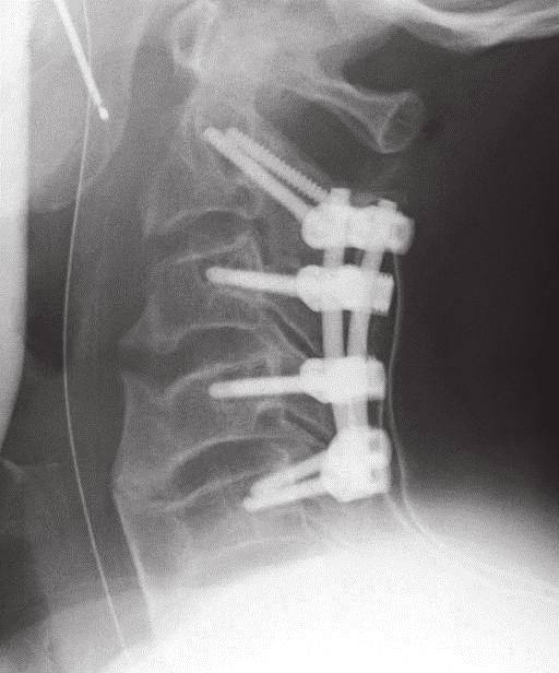 156 CT Scanning Techniques and Applications A B Fig. 7. Posterior instrumentation surgery for the cervical spine. A. Postoperative plain radiograph showing good fixation with cervical instrumentation.