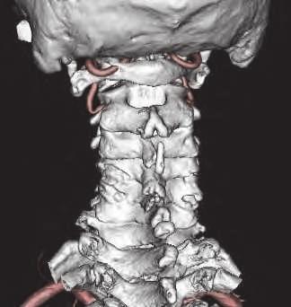 Efficacy of Preoperative CT Imaging in Posterior Cervical Spine Surgery 157 Fig. 8. Preoperative contrast 3DCT. 3DCT can be used to define the relationship between the lamina and VA.