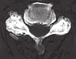 B C Fig. 1. Preoperative CT findings. A.