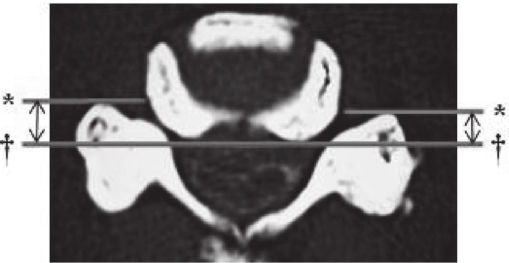 B) Anterior protrusion of the C5 superior articular process (SAP) (double arrow). indicates the posterior line of the vertebral column.