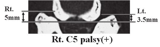 Efficacy of Preoperative CT Imaging in Posterior Cervical Spine Surgery 153 A B C Fig. 4.