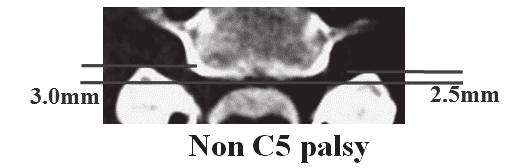 The protrusion was most prominent on the paralysis side (* p < 0.05: palsy side vs. normal side, **** p < 0.