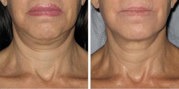 Advanced Techniques Neck lift (Nefertiti lift) This technique relaxes the muscular bands