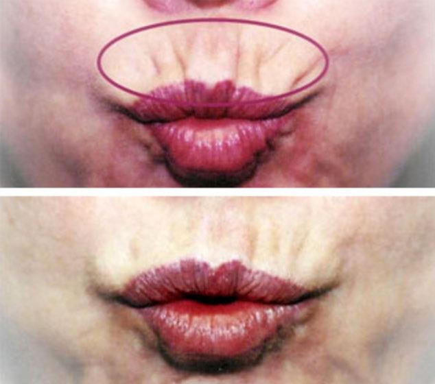 Advanced Techniques Smoker s Lines These perioral lines are created by the activity of