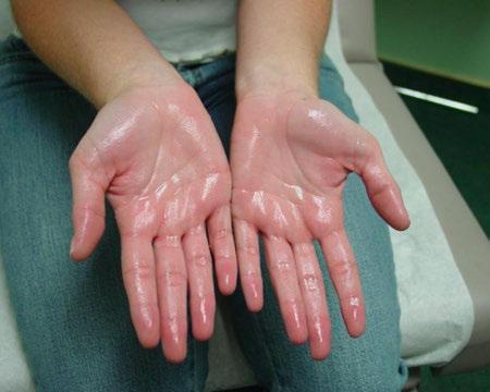 be used to treat defined areas (not useful in generalised hyperhidrosis) Note treatment of palmar hyperhidrosis can be very painful and therefore a nerve block