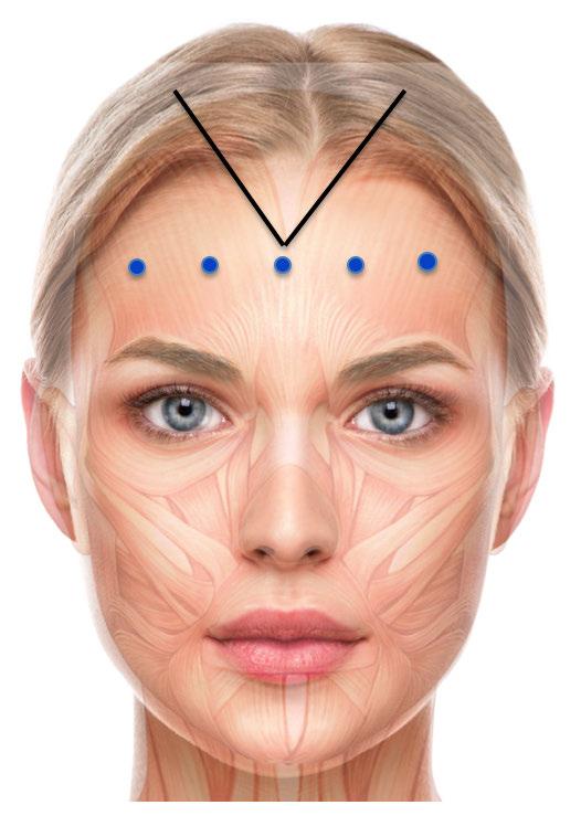 Technique Forehead Region Standard Injection Sites: Typically 5 injection sites Low dose, superficial injections to treat the broad and Flat frontalis muscle Injections