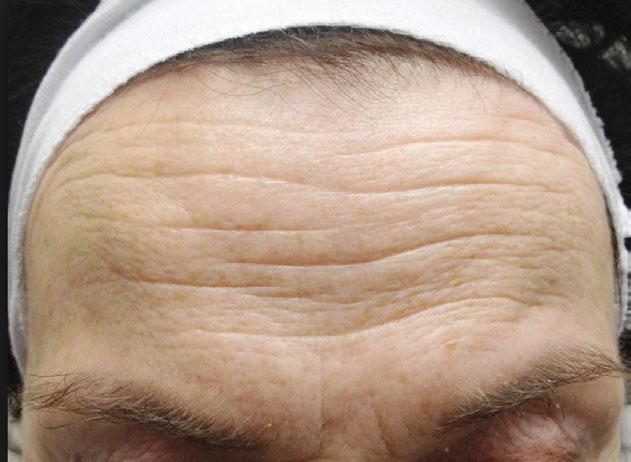Technique Forehead Region Treatment Tips: Straight row or zig-zag pattern