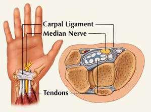 IAOH - 2013 65 Carpal Tunnel Syndrome Causes- swelling of flexor tendons due to repeated