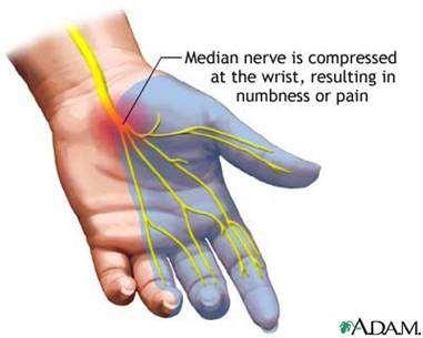 Repeated or prolonged nonneutral wrist postures. Blunt Trauma.