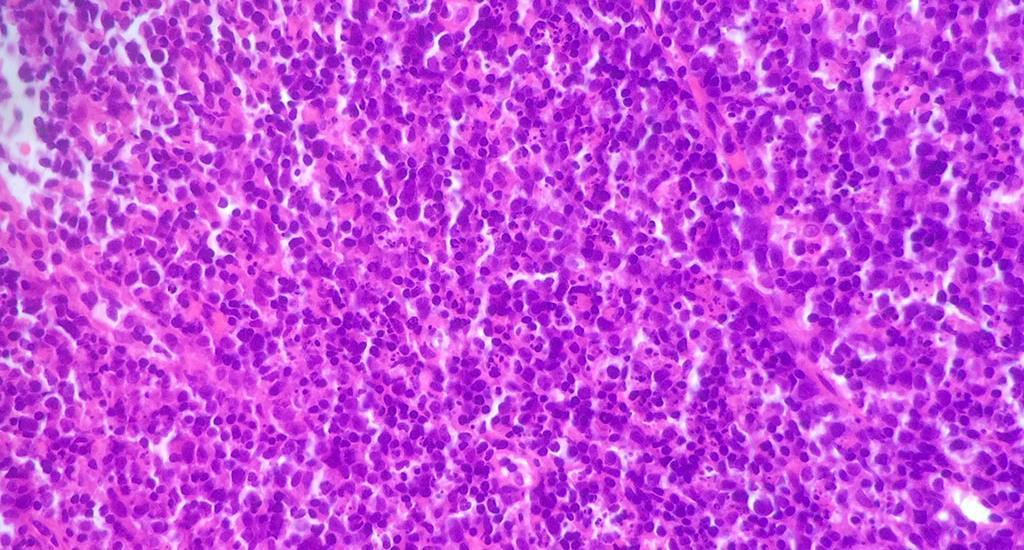 Is this a lymphoma?